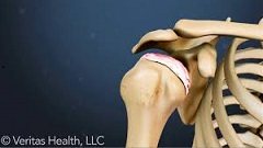 shoulder osteoarthritis video, shoulder DJD